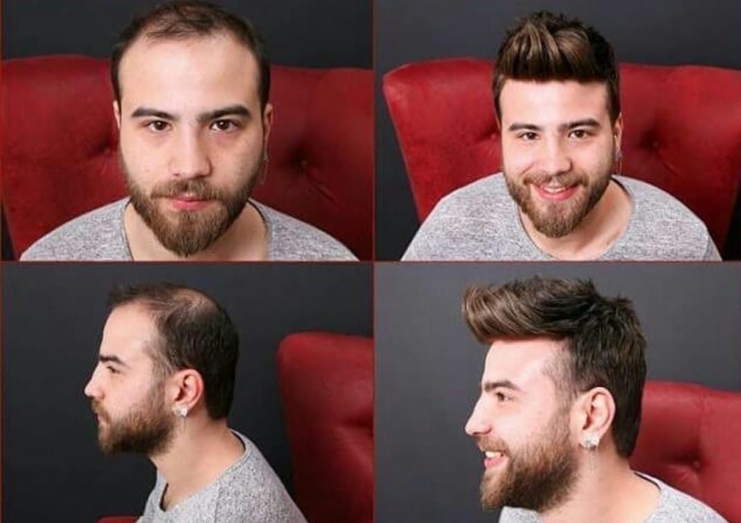 Protez saç öncesi ve sonrası örnek